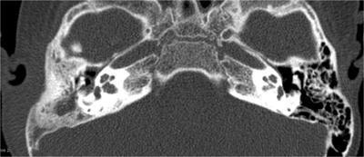 An in-depth discussion of cholesteatoma, middle ear Inflammation, and langerhans cell histiocytosis of the temporal bone, based on diagnostic results